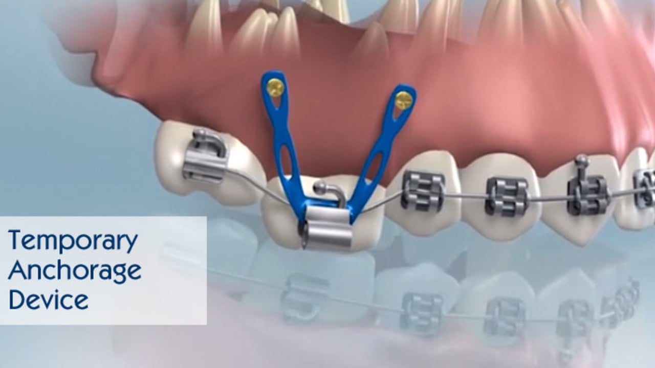 Orthodontic Treatment in Tampa, FL for Invisalign and Braces