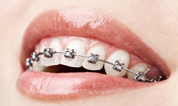 Orthodontic Treatment in Tampa