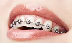 Orthodontic Treatment in Tampa