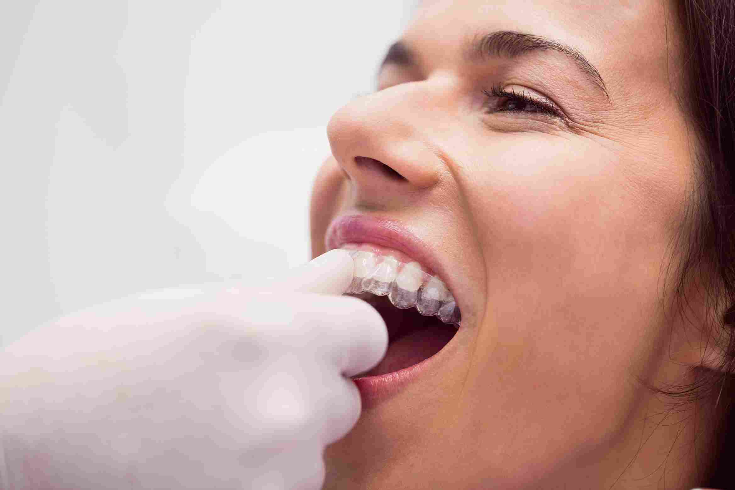 Advantages-of-Invisalign-in-Tampa