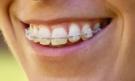 braces in tampa fl
